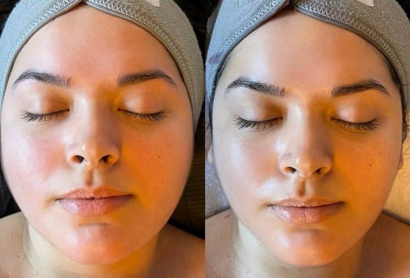 Skin Rejuvenation