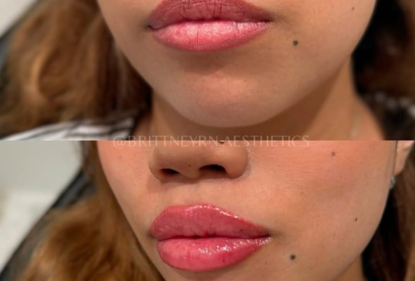 Injectable Treatments