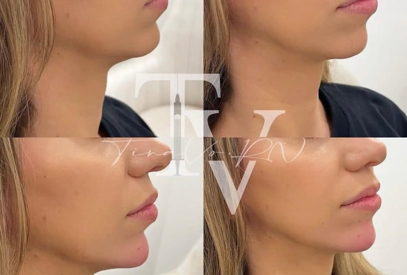 Double Chin & Jawline Contouring