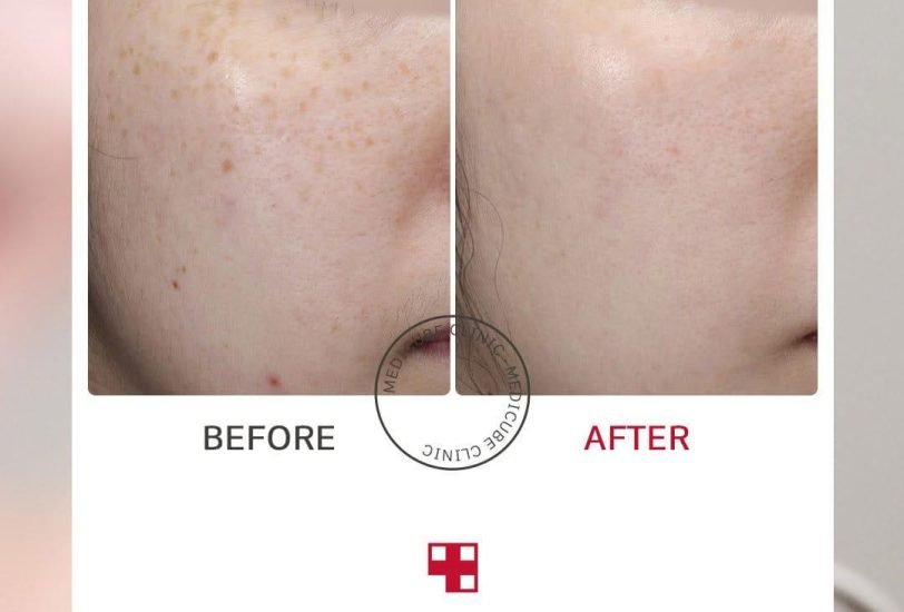 Acne & Scar Treatments