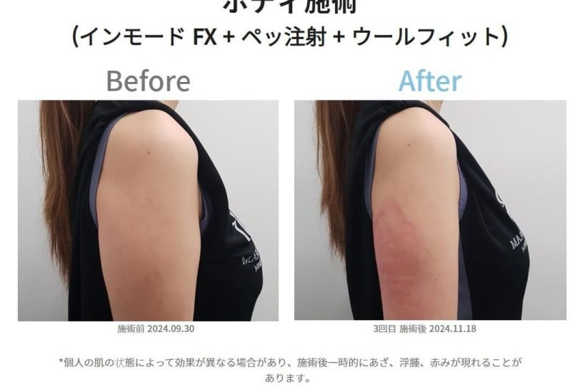 Muscle Toning