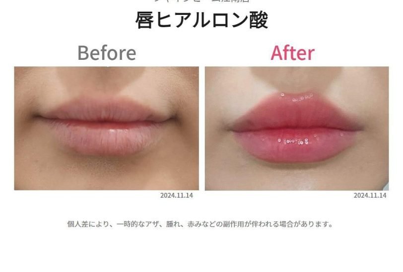 Lips Treatments