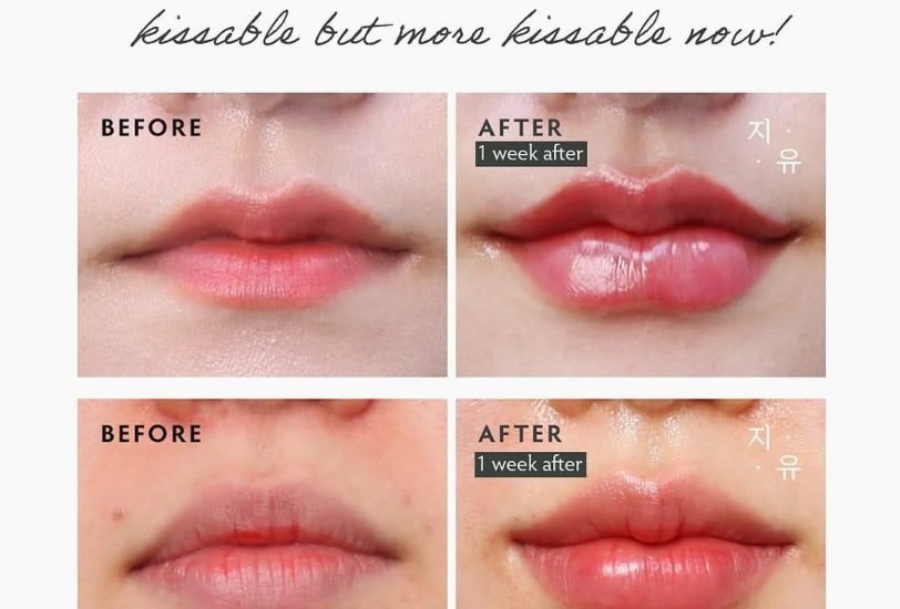 Lips Treatments