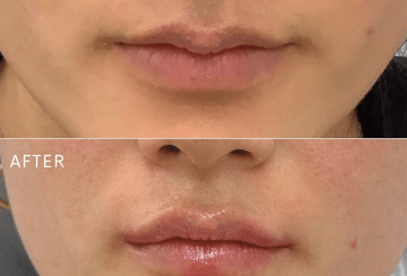 Lips Treatments
