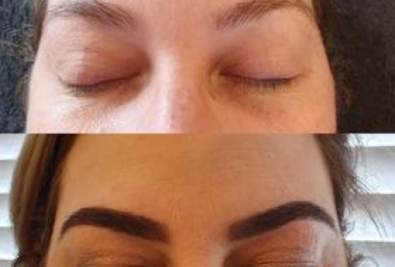 Eye Rejuvenation