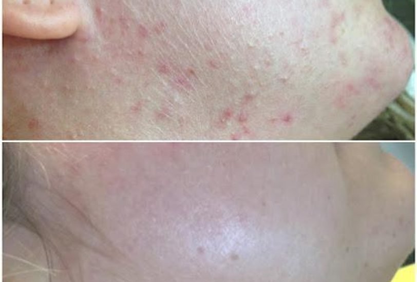 Pore & Texture Refinement