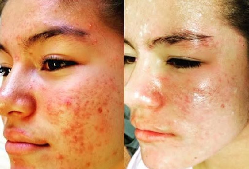 Acne & Scar Treatments