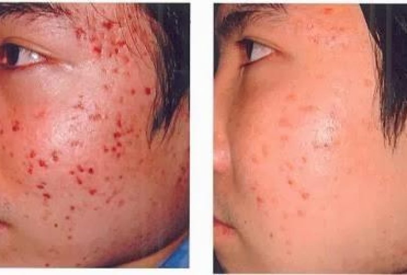 Acne & Scar Treatments
