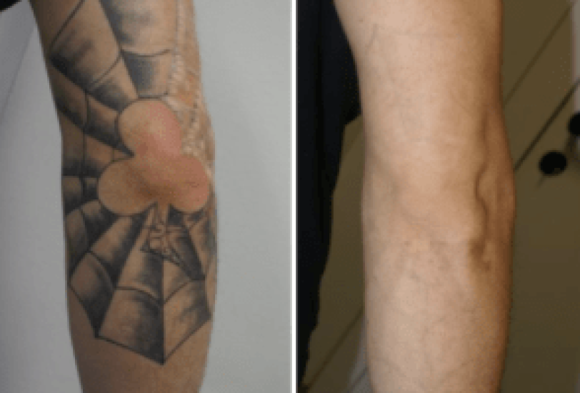Scar Revision Treatments