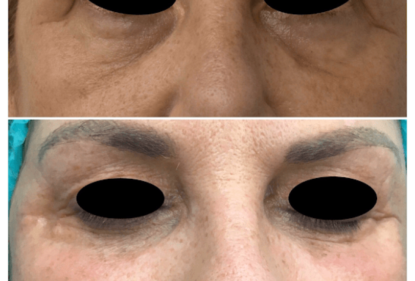 Skin Tightening