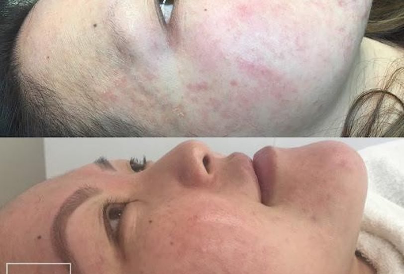 Acne & Scar Treatments