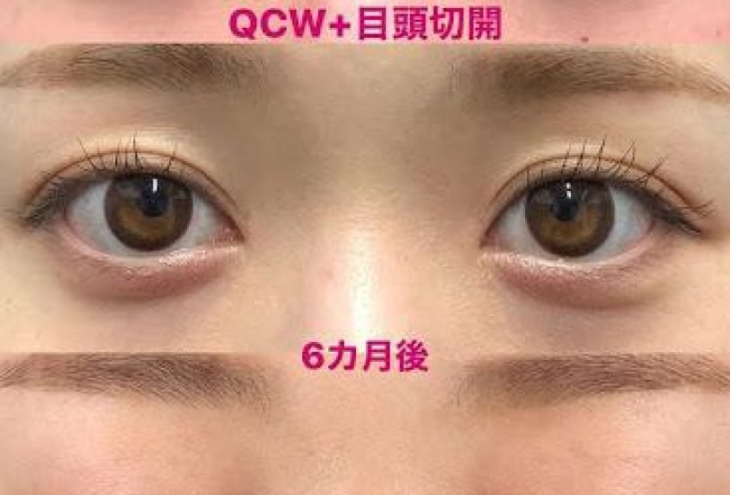 Eye Rejuvenation